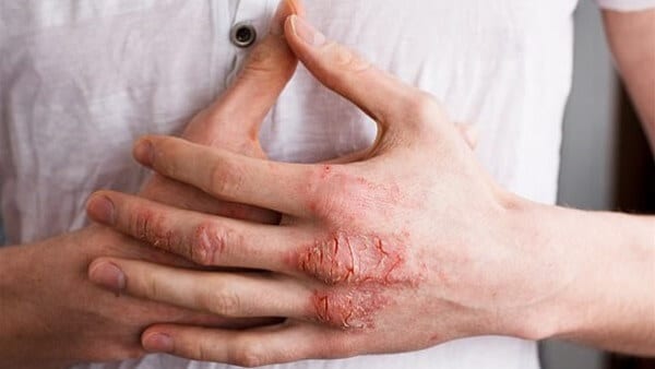 علاج اكزيما اليدين بالاعشاب